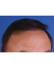 After Hair Transplant&nbsp;Front